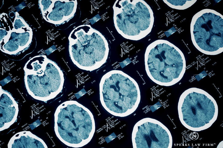 TBIs range from mild concussions