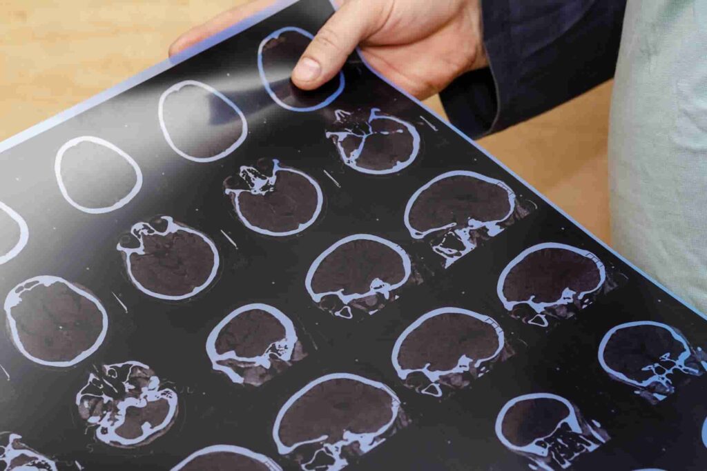 Traumatic Brain Injury TBI Lawyers Wilmington | Call (910) 341-7570